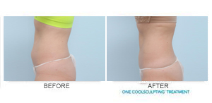 Coolsculpting Before and After Pictures in Houston, Tx
