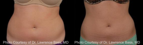 Coolsculpting before and after pictures in Houston, TX, Patient 101