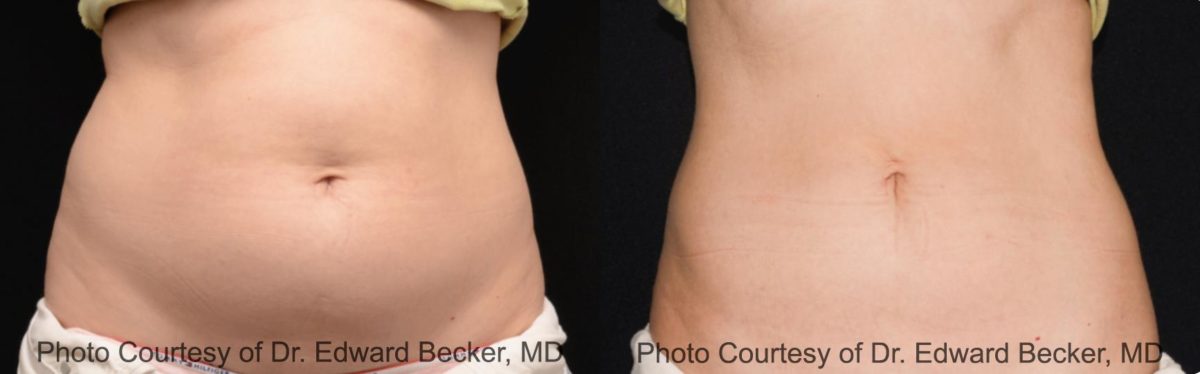 Coolsculpting before and after pictures in Houston, TX, Patient 104