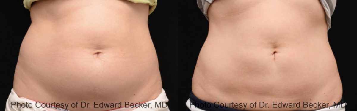 Coolsculpting before and after pictures in Houston, TX, Patient 104