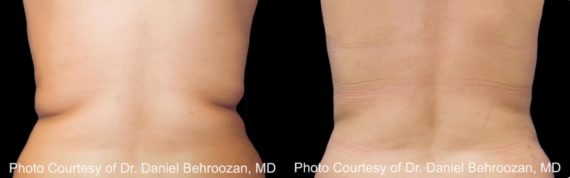 Coolsculpting before and after pictures in Houston, TX, Patient 109