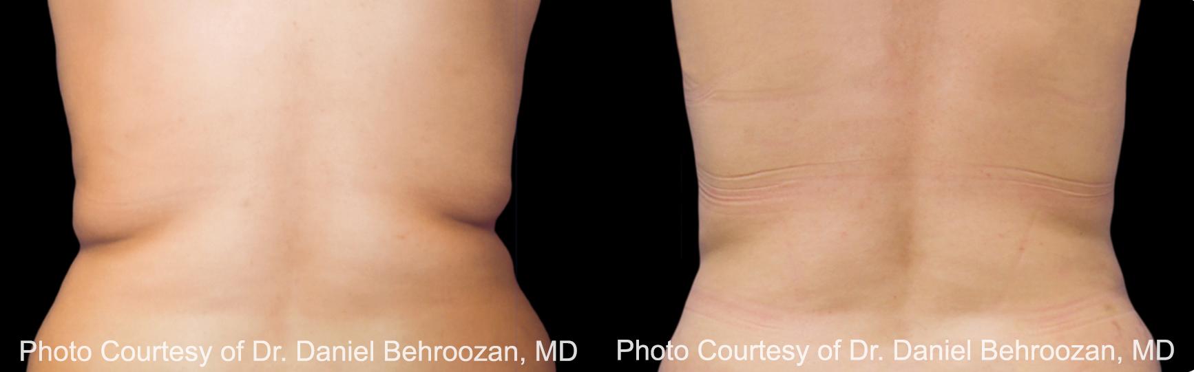  before and after pictures in , , The Difference Between Traditional Weight Loss and CoolSculpting