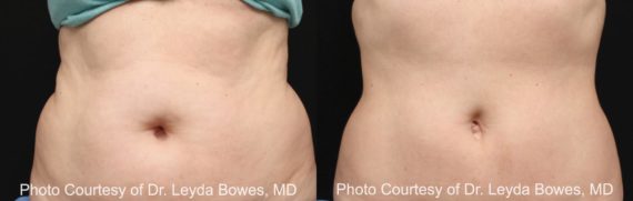 Coolsculpting before and after pictures in Houston, TX, Patient 114
