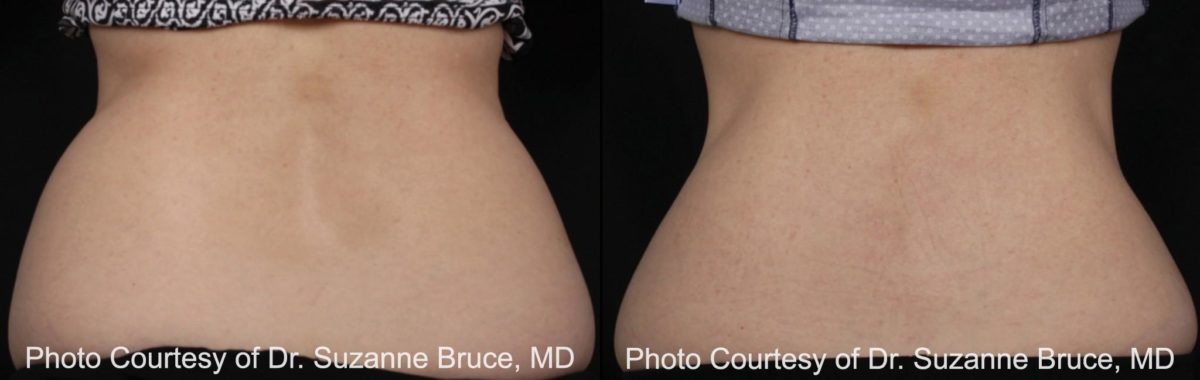 Coolsculpting before and after pictures in Houston, TX, Patient 117