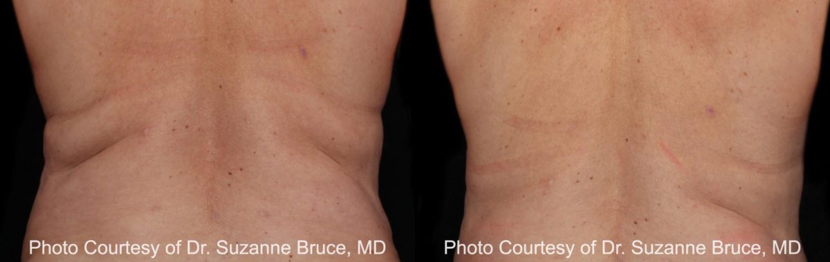 Coolsculpting before and after pictures in Houston, TX, Patient 120