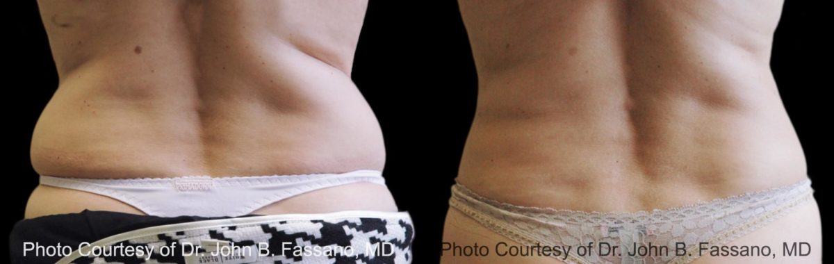 Coolsculpting before and after pictures in Houston, TX, Patient 123