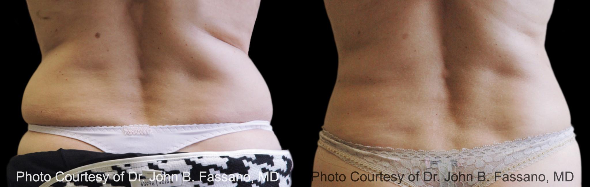  before and after pictures in , , The Difference Between Traditional Weight Loss and CoolSculpting