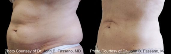 Coolsculpting before and after pictures in Houston, TX, Patient 123