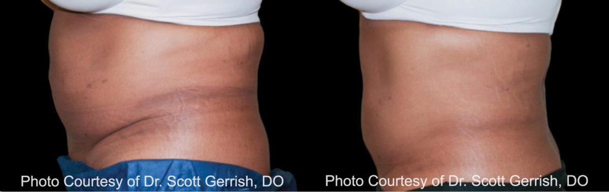 Coolsculpting before and after pictures in Houston, TX, Patient 128