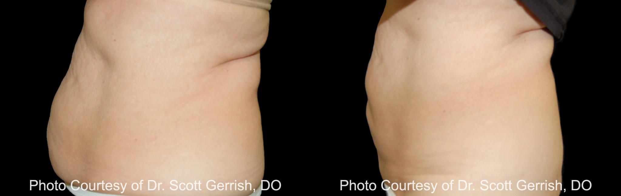  before and after pictures in , , Debra Messing for CoolSculpting