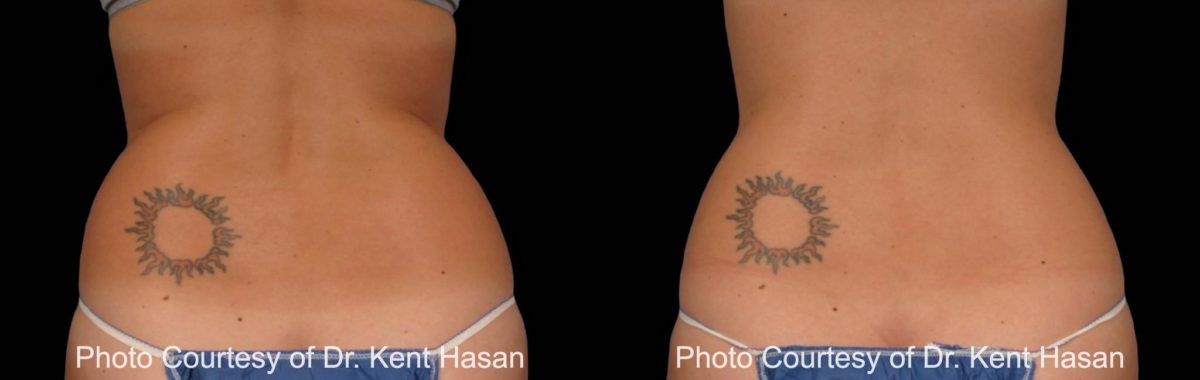 Coolsculpting before and after pictures in Houston, TX, Patient 134