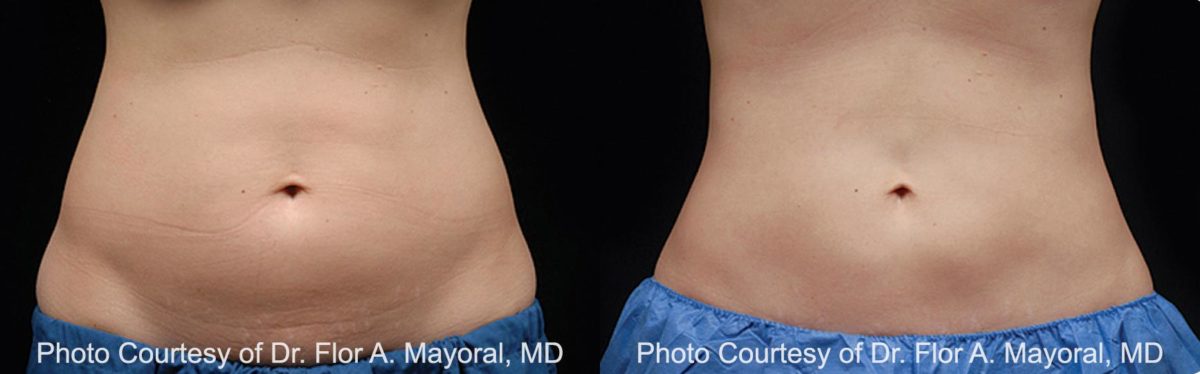 Coolsculpting before and after pictures in Houston, TX, Patient 137
