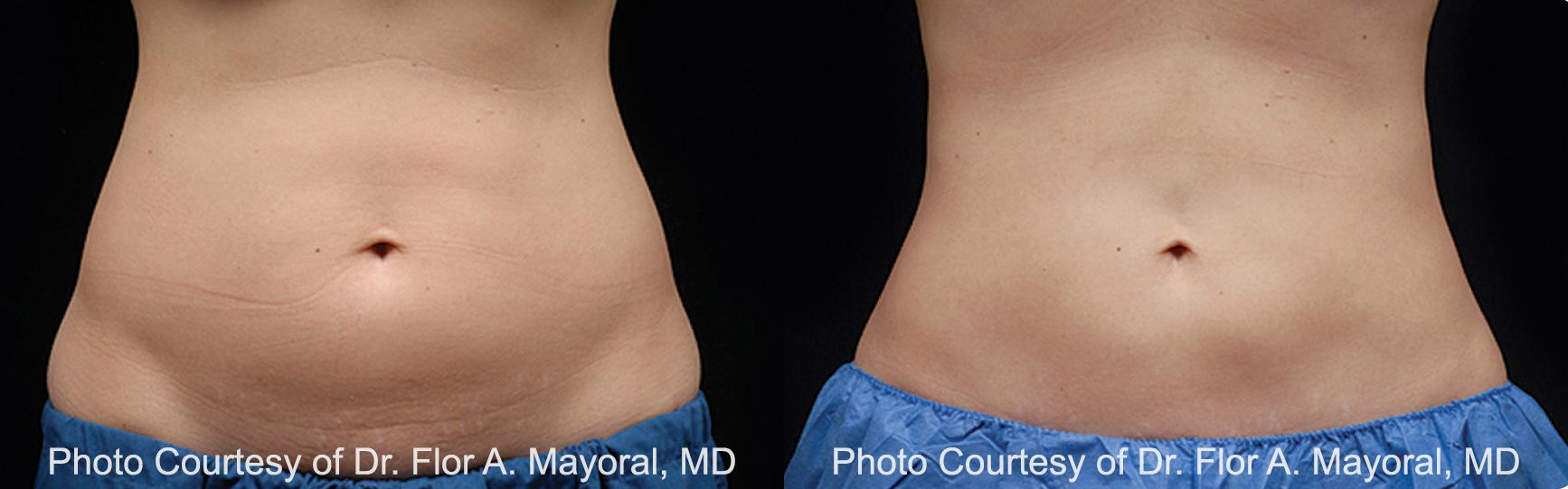  before and after pictures in , , Five ‘Must Ask” Questions for Your CoolSculpting Consultation