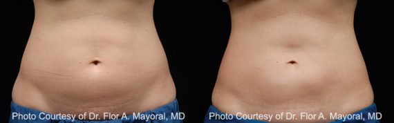 Coolsculpting before and after pictures in Houston, TX, Patient 137