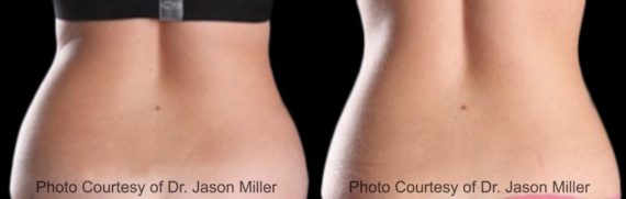 Coolsculpting before and after pictures in Houston, TX, Patient 142
