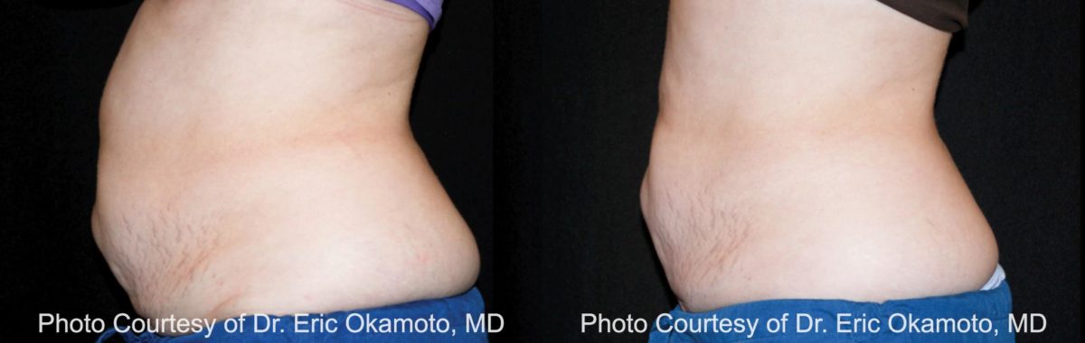 Coolsculpting before and after pictures in Houston, TX, Patient 145