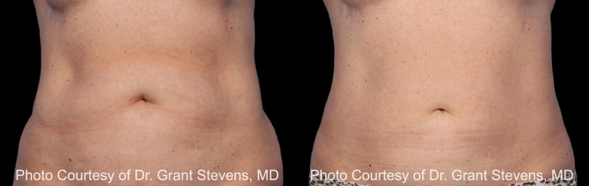 Coolsculpting before and after pictures in Houston, TX, Patient 148