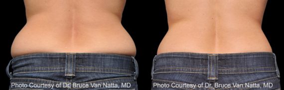 Coolsculpting before and after pictures in Houston, TX, Patient 151
