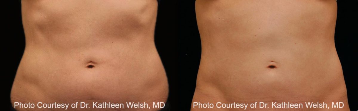Coolsculpting before and after pictures in Houston, TX, Patient 154