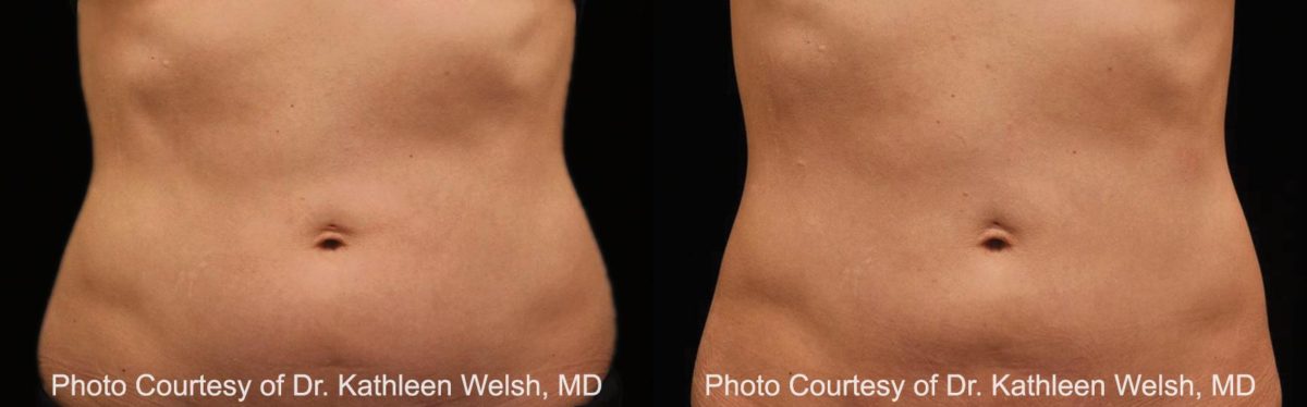Coolsculpting before and after pictures in Houston, TX, Patient 154