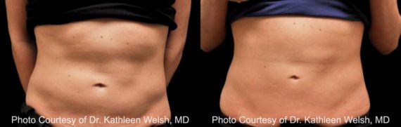 Coolsculpting before and after pictures in Houston, TX, Patient 159