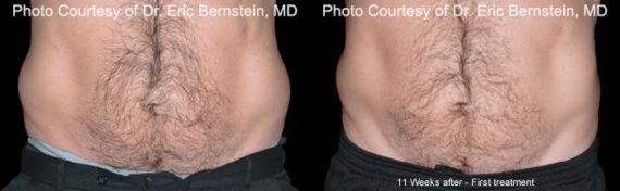 Coolsculpting before and after pictures in Houston, TX, Patient 162