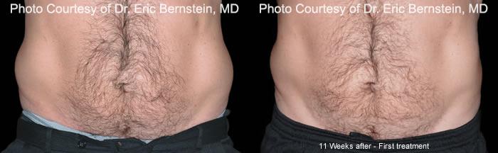 Coolsculpting before and after pictures in Houston, TX, Patient 162