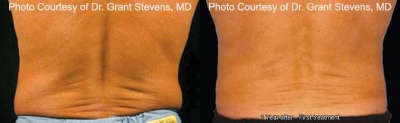 Coolsculpting before and after pictures in Houston, TX, Patient 168