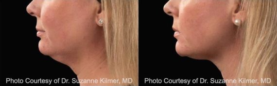 Coolsculpting before and after pictures in Houston, TX, Patient 171