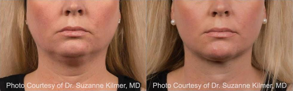  before and after pictures in , , Reduce Double Chin Fat in Houston, TX