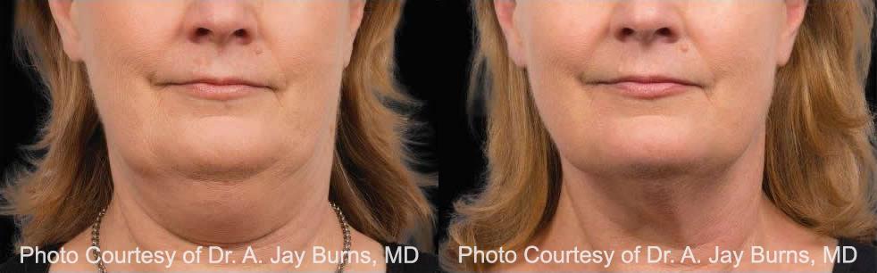  before and after pictures in , , Double-down on Your Double Chin: CoolSculpting Fights Both Fat and Skin Laxity