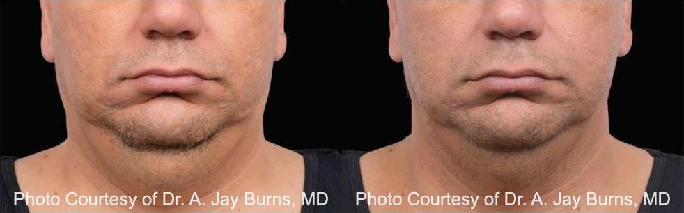 Coolsculpting before and after pictures in Houston, TX, Patient 181