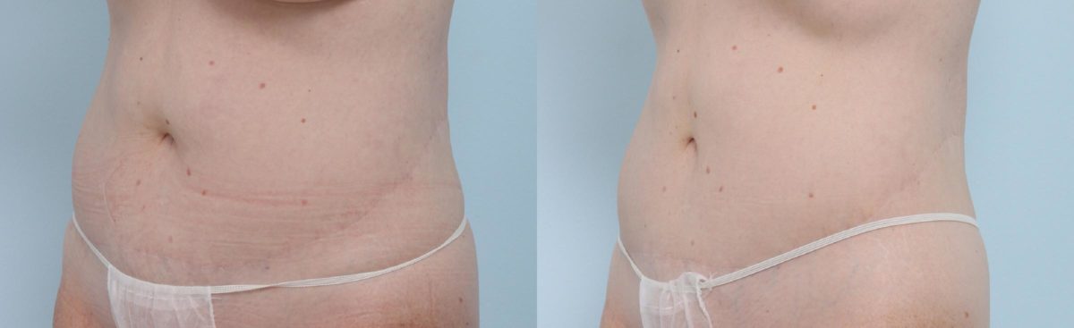 Coolsculpting before and after pictures in Houston, TX, Patient 683