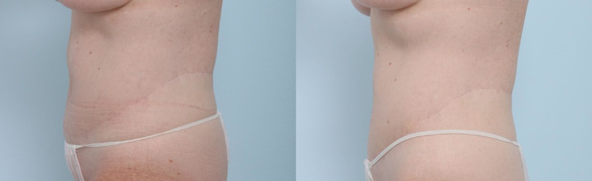 Coolsculpting before and after pictures in Houston, TX, Patient 683