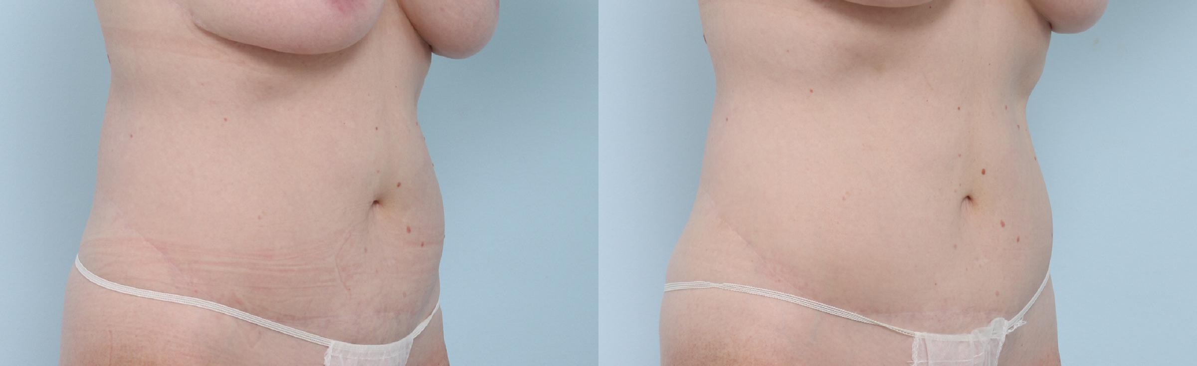  before and after pictures in , , So Many CoolSculpting Applicators, So Little Time!
