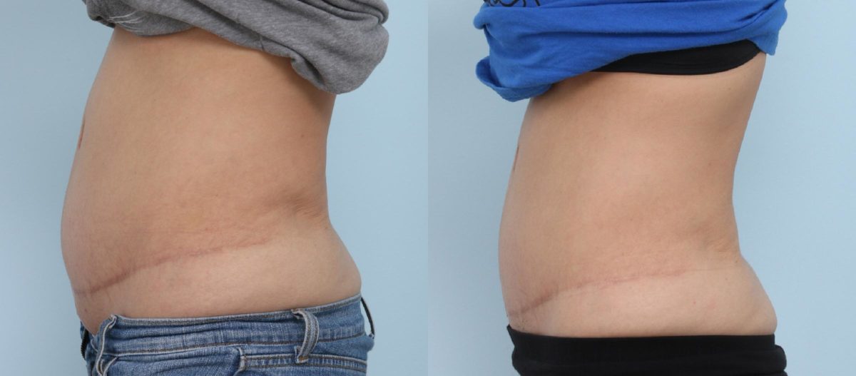 Coolsculpting before and after pictures in Houston, TX, Patient 700