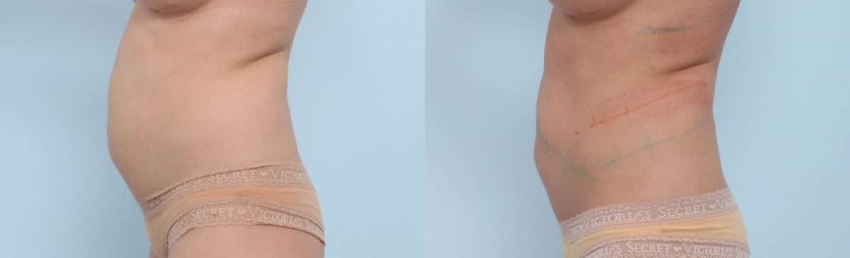 Coolsculpting before and after pictures in Houston, TX, Patient 704