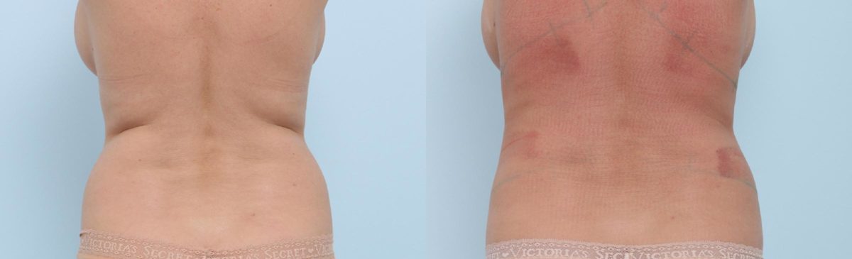Coolsculpting before and after pictures in Houston, TX, Patient 704