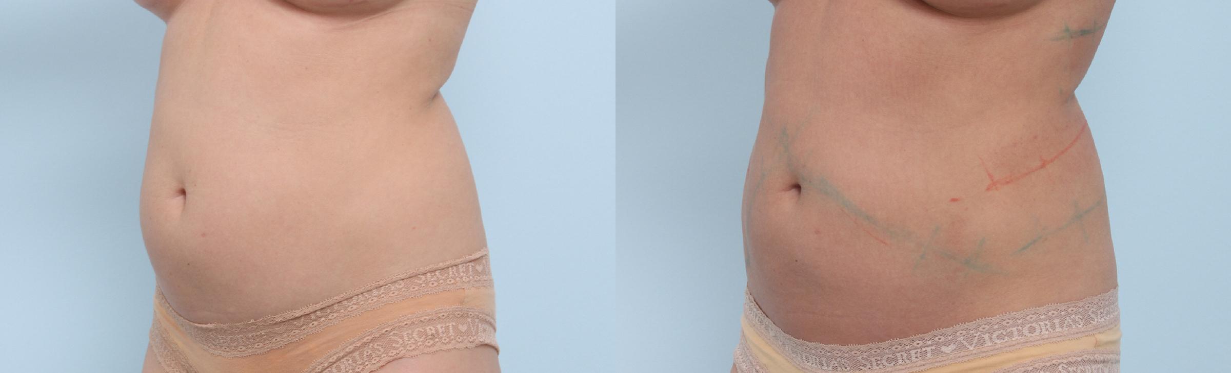  before and after pictures in , , How much does CoolSculpting cost?