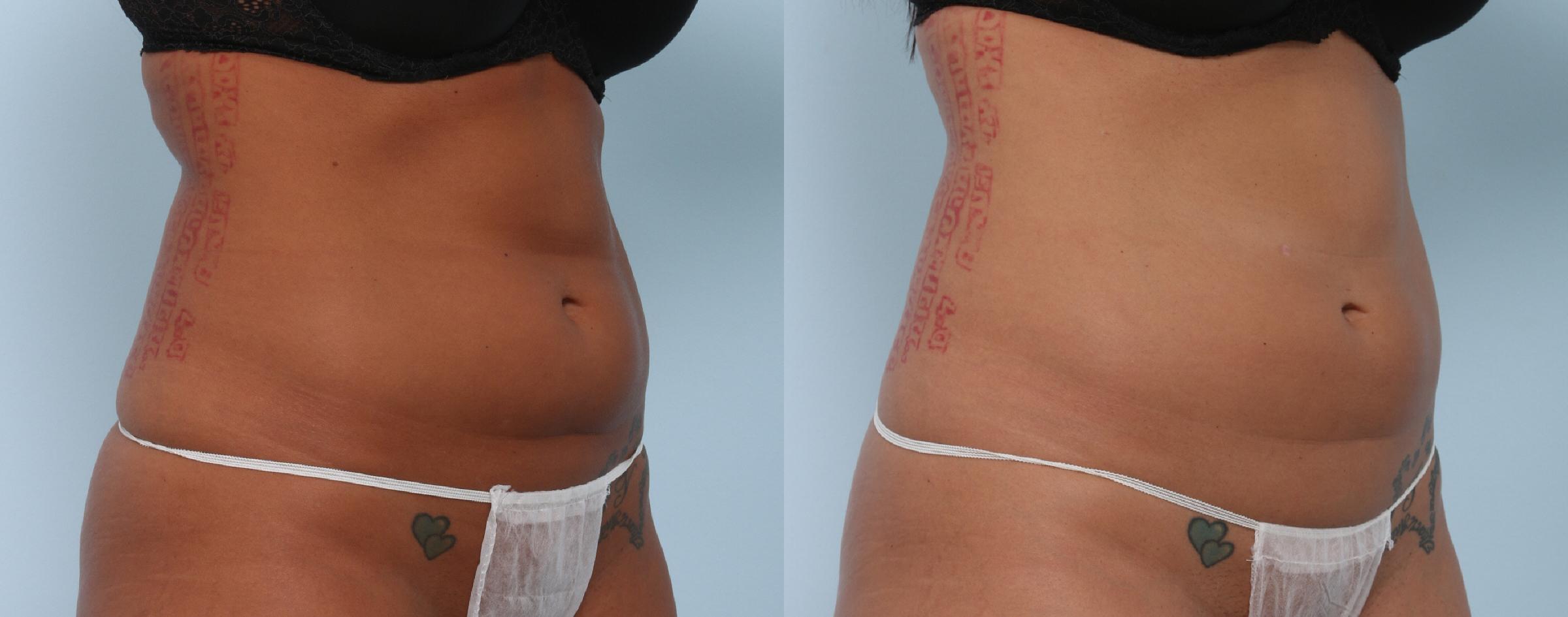  before and after pictures in , , What in the World is Cryolipolysis?