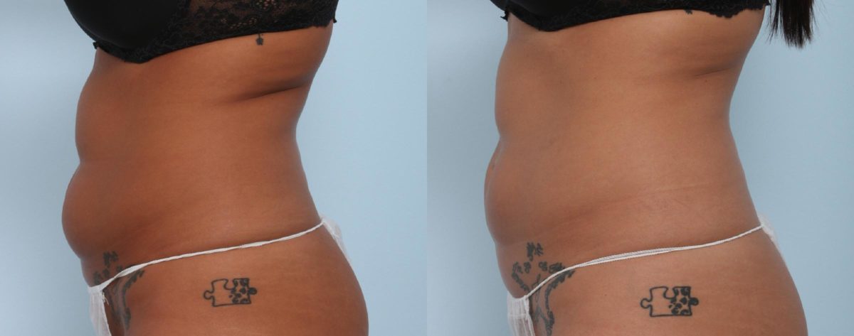 Coolsculpting before and after pictures in Houston, TX, Patient 714