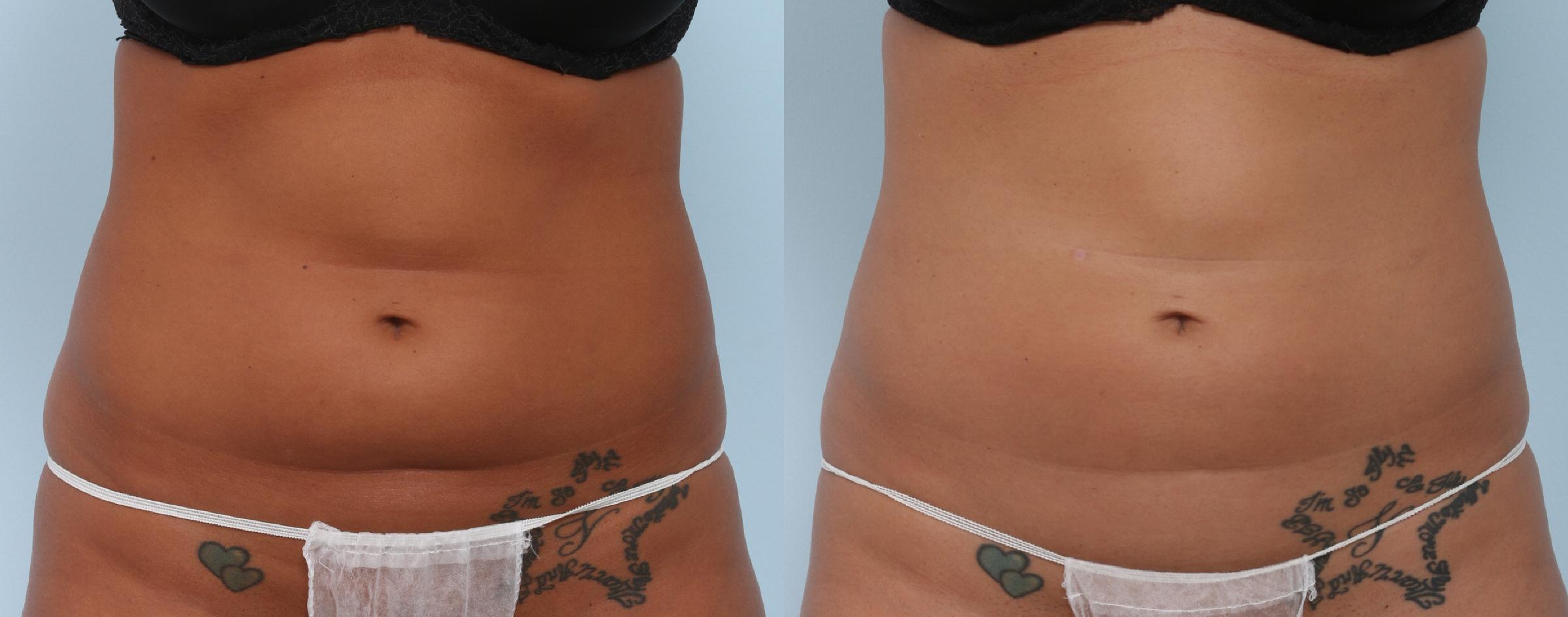  before and after pictures in , , Chin Up: Why You Should Consider CoolSculpting for Submental Fat