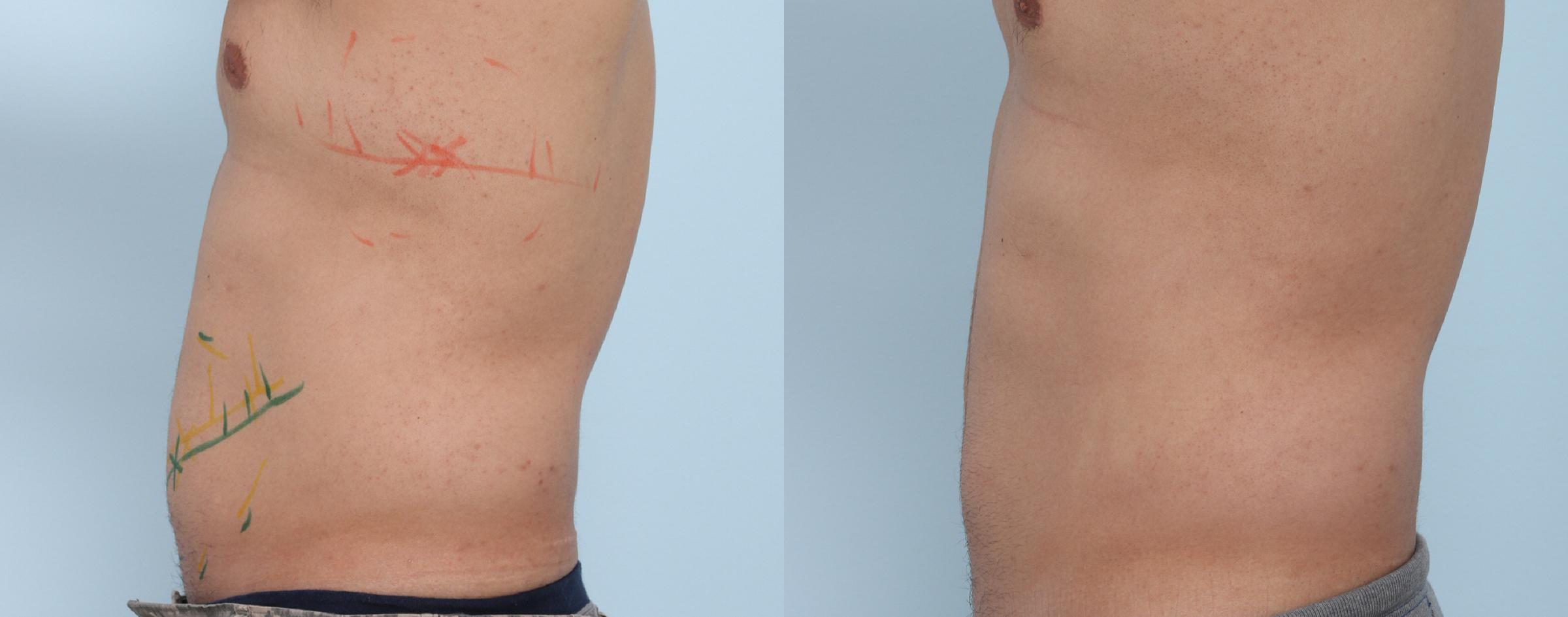  before and after pictures in , , CoolSculpting for Couples