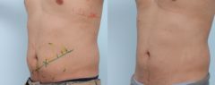 Coolsculpting before and after pictures in Houston, TX, Patient 724