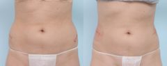 Coolsculpting before and after pictures in Houston, TX, Patient 731