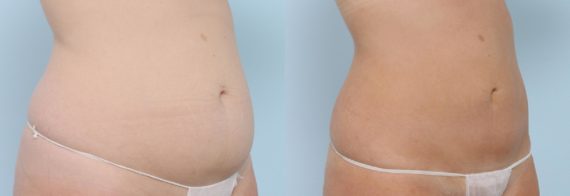 Coolsculpting before and after pictures in Houston, TX, Patient 735
