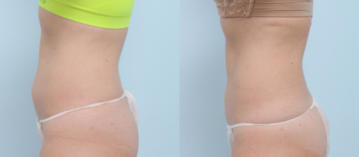 Coolsculpting before and after pictures in Houston, TX, Patient 751
