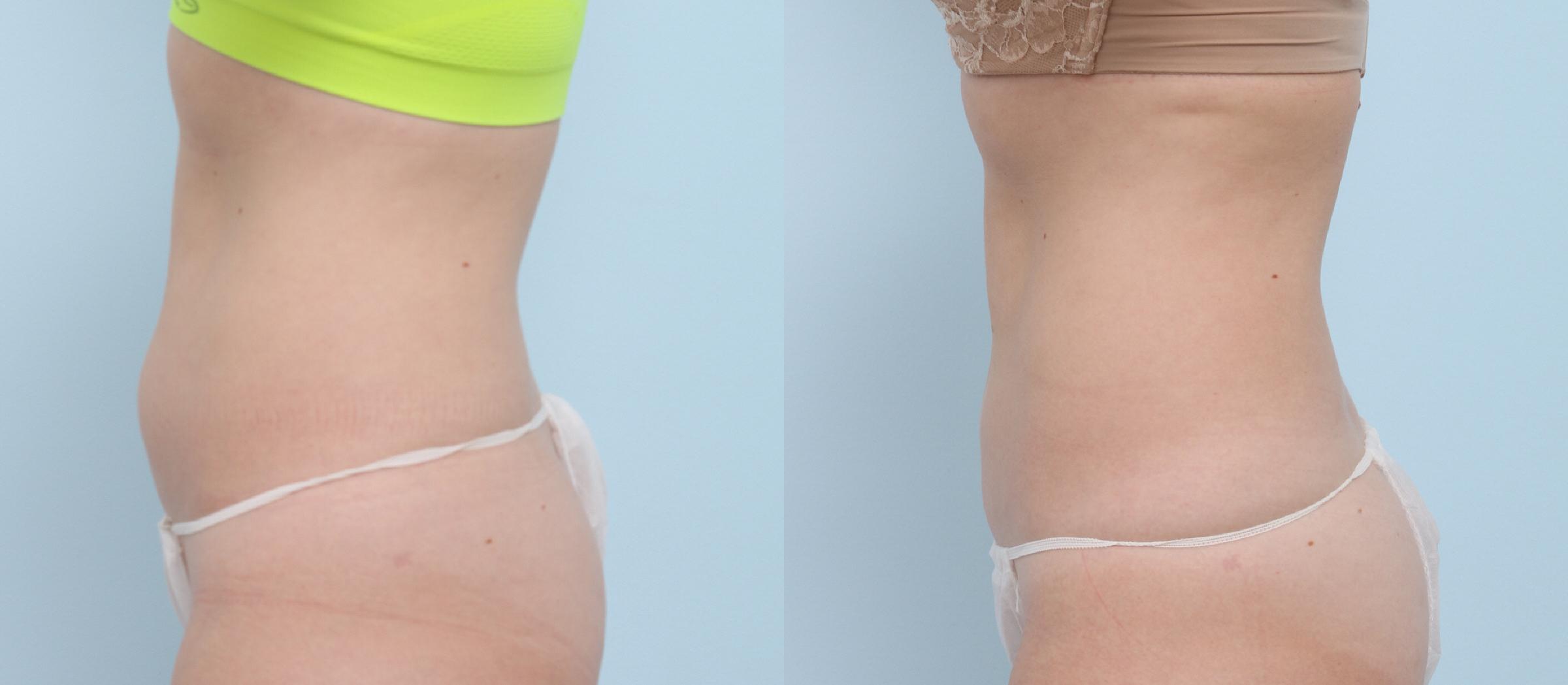  before and after pictures in , , Six Areas You Can Freeze Away Fat Forever