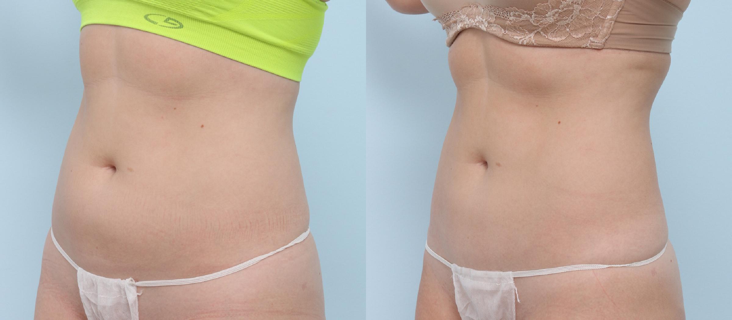  before and after pictures in , , Six Areas You Can Freeze Away Fat Forever