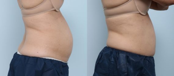 Coolsculpting before and after pictures in Houston, TX, Patient 763